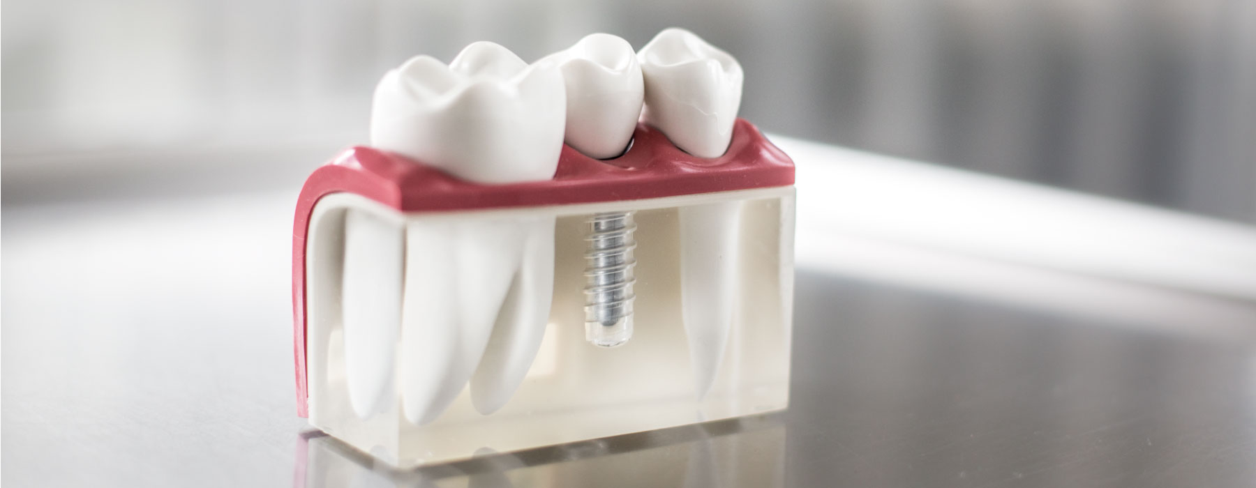 Modell eines Zahnimplantats 