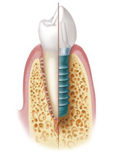 Beispielmodell Zahnimplantat des Kieferchirurg Brühl